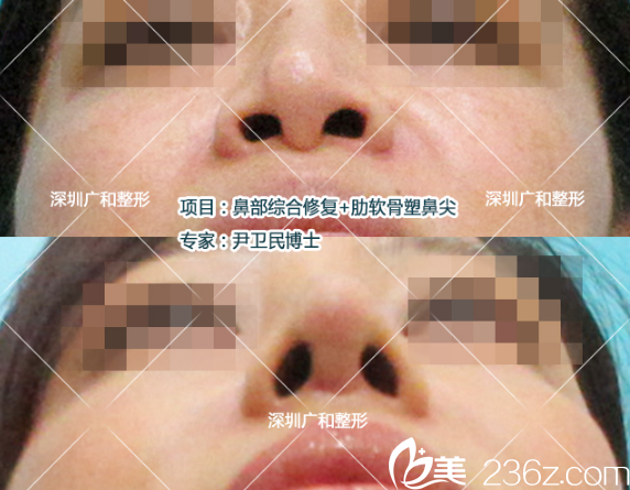 公开隆鼻失败4次找深圳广和尹卫民做鼻子修复和自体肋软骨塑鼻尖的经历