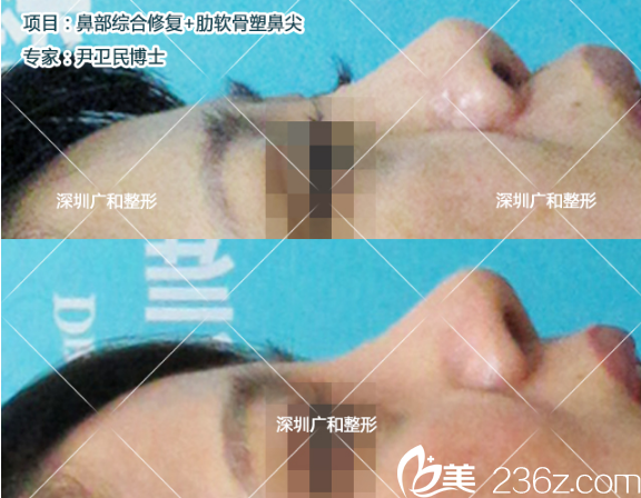 尹卫民鼻修复案例鼻孔细节前后对比图