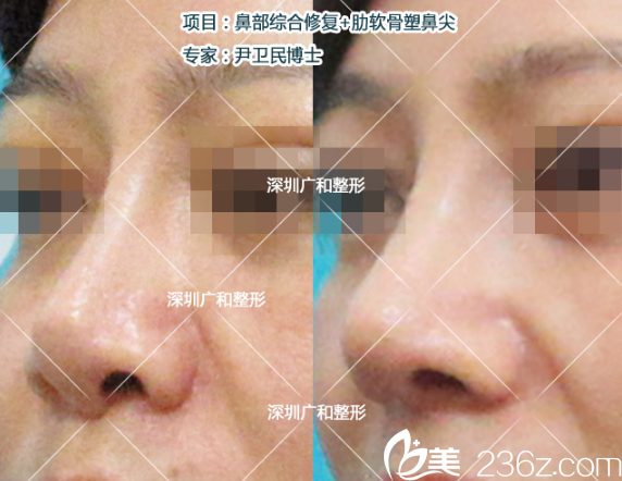 鼻修复术前术后半侧面细节对比