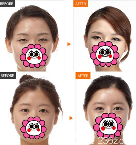 蚌埠国色整形美容医院朱宝玉做眼部整形案例前后对比图 蚌埠国色整形美容医院朱宝玉做眼部整形案例前后对比图