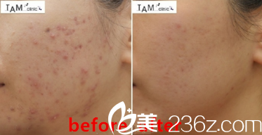 祛痘真人前后效果对比 祛痘真人前后效果对比