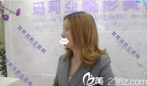 宜宾玛莉亚整形医院鼻综合案例 宜宾玛莉亚整形医院鼻综合案例