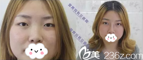 宜宾玛莉亚整形医院鼻综合术后正面对比 宜宾玛莉亚整形医院鼻综合术后正面对比