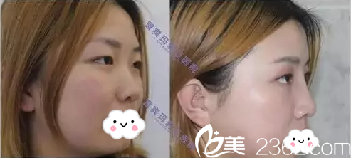 宜宾玛莉亚整形医院鼻综合术后侧面对比 宜宾玛莉亚整形医院鼻综合术后侧面对比