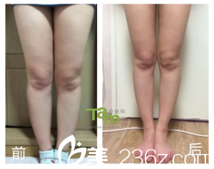 瘦腿前后效果对比 瘦腿前后效果对比