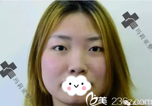 鼻综合术前塌鼻梁圆鼻头 鼻综合术前塌鼻梁圆鼻头