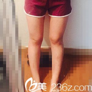 秒变长腿女神，看我在韩国劳波儿做的吸脂瘦大腿一个月恢复过程