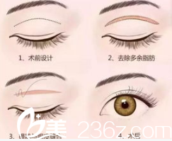 北京金圣医疗美容诊所双眼皮形成示意图