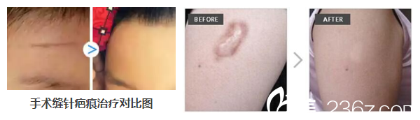 <!--<i data=20240703-sp></i>-->医生激光祛疤案例