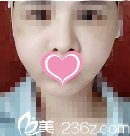 颧骨整形第四天