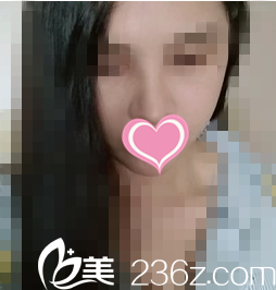 术后二十天效果