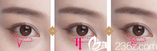 DI整形医院双眼皮示意图 DI整形医院双眼皮示意图