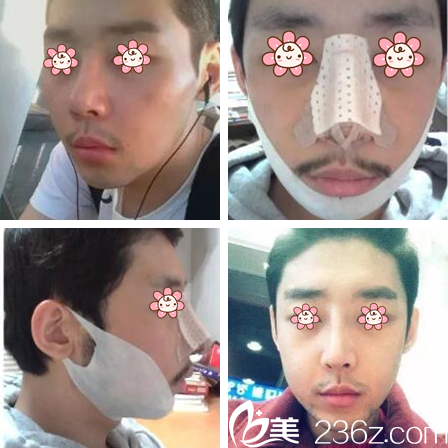 金亨珍院长面部轮廓加鼻综合案例 金亨珍院长面部轮廓加鼻综合案例