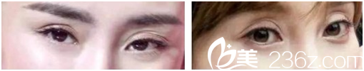 双眼皮贴造成眼皮多层折痕 双眼皮贴造成眼皮多层折痕