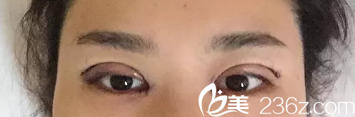 术后即刻效果图 术后即刻效果图