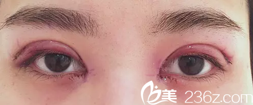 术后天肿胀期效果图 术后天肿胀期效果图