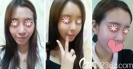 宋寅洙院长面部脂肪填充案例 宋寅洙院长面部脂肪填充案例