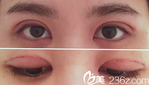 术后一周拆线效果图 术后一周拆线效果图