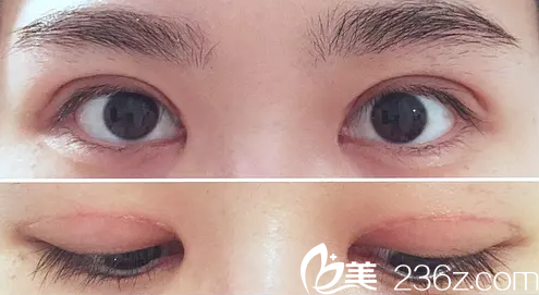 术后一个月效果图 术后一个月效果图