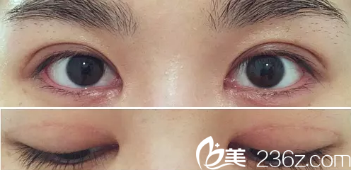 术后两个月效果图 术后两个月效果图