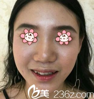 去韩国金亨珍纽莱茵整形外科前的我 去韩国金亨珍纽莱茵整形外科前的我