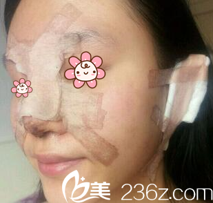 宋寅洙院长给我手术完第二天 宋寅洙院长给我手术完第二天