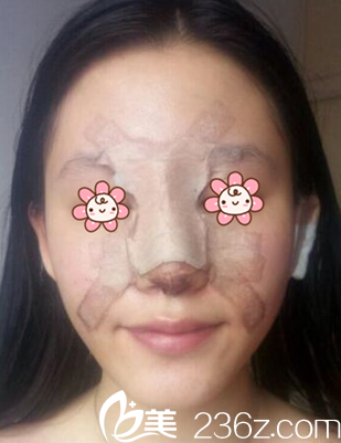 术后第四天 术后第四天