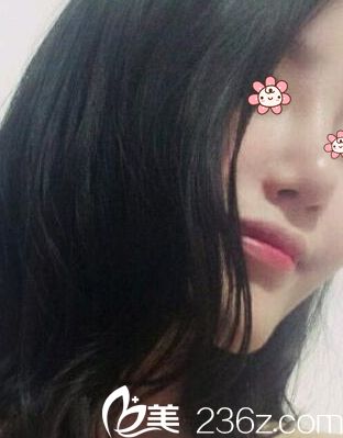 感觉一个月后鼻子越来越好看~ 感觉一个月后鼻子越来越好看~