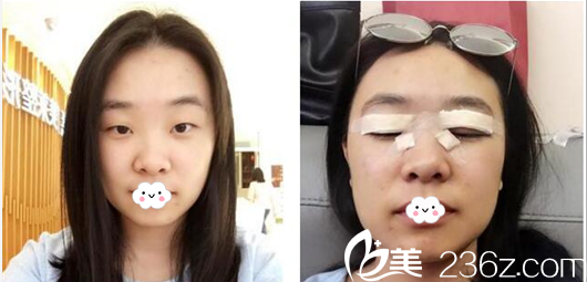 术前单眼皮照片 术前单眼皮照片