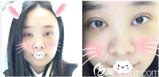 深圳美莱陈磊双眼皮案例第6天 深圳美莱陈磊双眼皮案例第6天