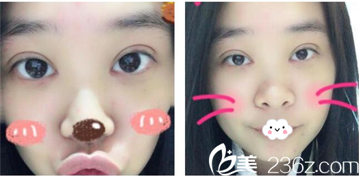 陈磊做的双眼皮案例第九天效果图 陈磊做的双眼皮案例第九天效果图