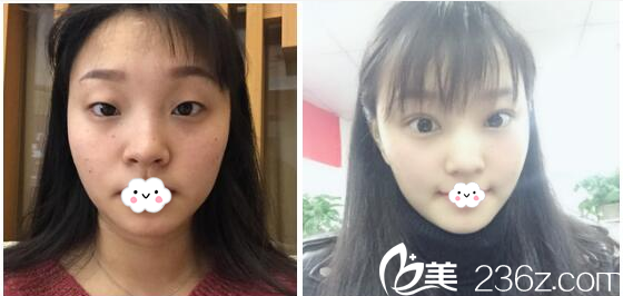 深圳美莱陈磊双眼皮案例对比图 深圳美莱陈磊双眼皮案例对比图