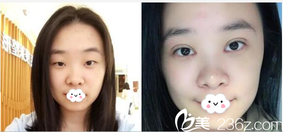 深圳美莱陈磊医生做的全切双眼皮案例 深圳美莱陈磊医生做的全切双眼皮案例