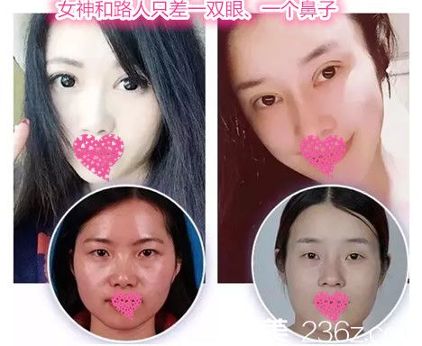 安庆维多利亚端木义勇做双眼皮和隆鼻怎么样？看端木义勇全切双眼皮+假体隆鼻案例对比图