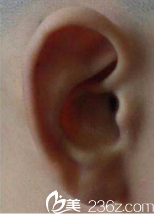 叙述我遭耳畸形后，让泉州180整形科的张如鸿成功的做了耳再造手术