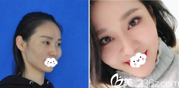 深圳富华整形医院屈晶做的双眼皮案例 深圳富华整形医院屈晶做的双眼皮案例