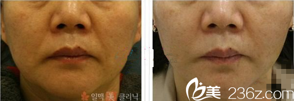 韩国一脉美面部提升去皱手术 韩国一脉美面部提升去皱手术