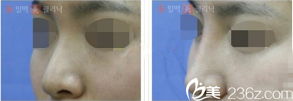 韩国一脉美注射隆鼻 韩国一脉美注射隆鼻