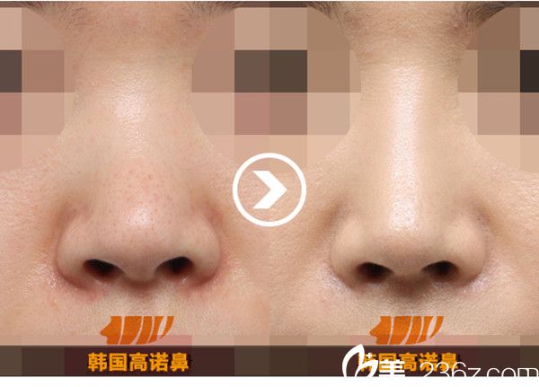 韩国高诺鼻CONOPI整形外科医院隆鼻案例 韩国高诺鼻CONOPI整形外科医院隆鼻案例