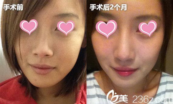 韩国高诺鼻CONOPI整形外科医院隆鼻安利了 韩国高诺鼻CONOPI整形外科医院隆鼻安利了