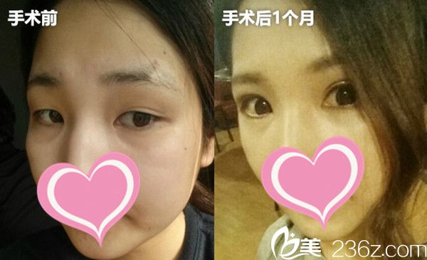 韩国高诺鼻CONOPI整形外科医院双眼皮案例