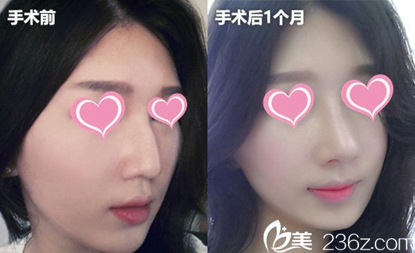 郑太英院长隆鼻手术真人案例 郑太英院长隆鼻手术真人案例