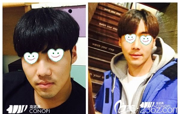 林志贤院长隆鼻手术真人案例 林志贤院长隆鼻手术真人案例