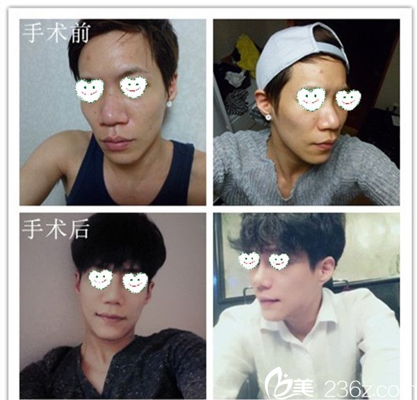 韩国高诺鼻CONOPI整形外科医院案例 韩国高诺鼻CONOPI整形外科医院案例