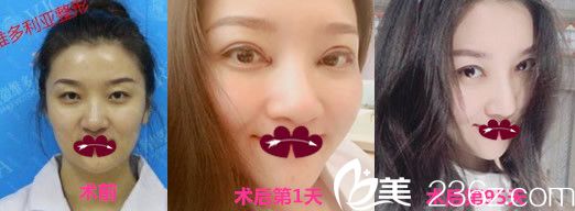 维多利亚徐和林双眼皮整形怎么样?看全切双眼皮整形案例效果图 维多利亚徐和林双眼皮整形怎么样?看全切双眼皮整形案例效果图