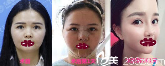 资深整形医生徐和林鼻综合隆鼻+下颌角整形案例恢复效果图展示 资深整形医生徐和林鼻综合隆鼻+下颌角整形案例恢复效果图展示