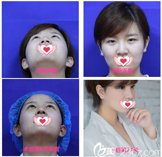 安徽维多利亚卫爱侠膨体假体隆鼻鼻综合恢复过程对比图 安徽维多利亚卫爱侠膨体假体隆鼻鼻综合恢复过程对比图