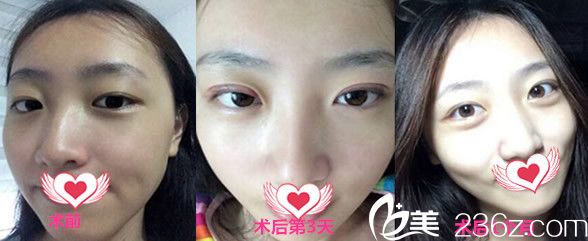 何贤清做双眼皮怎么样呢?看何贤清割双眼皮整形案例效果展示 何贤清做双眼皮怎么样呢?看何贤清割双眼皮整形案例效果展示