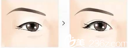 北京亚楠容悦医疗美容诊所开眼角效果示意图 北京亚楠容悦医疗美容诊所开眼角效果示意图