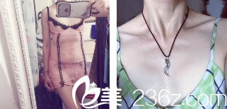 胸部术前图 胸部术前图